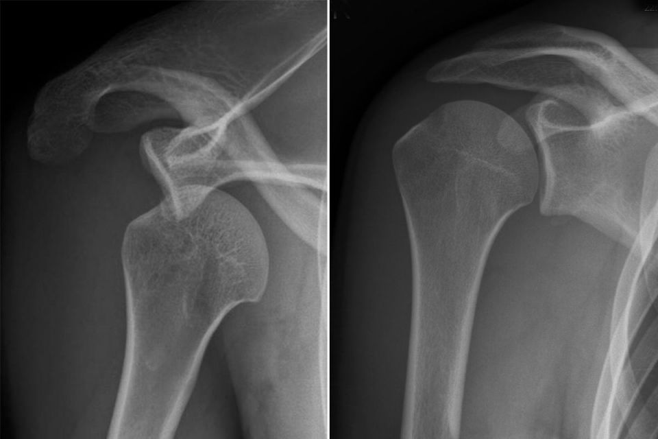 Schulterluxation Schulterinstabilität Behandlung KSW