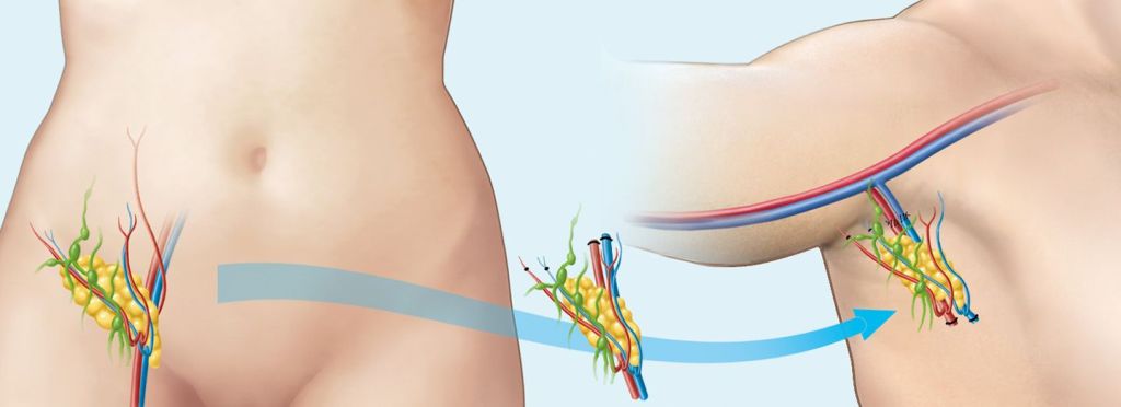 Lymph Dem Ursachen Und Behandlung Kantonsspital Winterthur