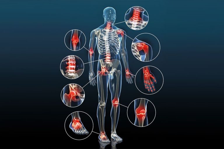 Arthrose / Gelenkverschleiss - Ursache, Diagnose Und Behandlung - KSW