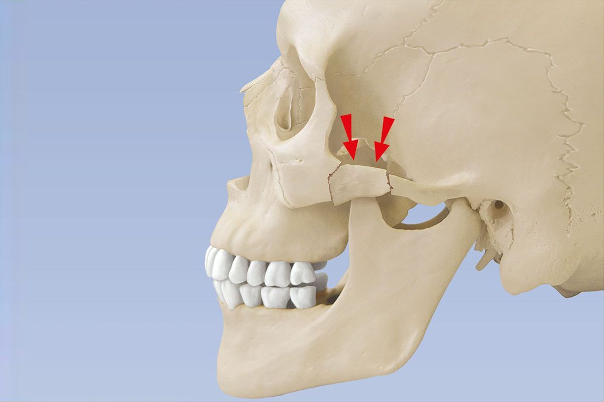 Jochbeinfraktur  Jochbeinbruch  Jochbogenfraktur | KSW