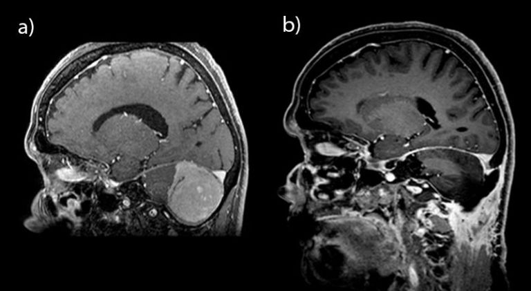 Hirntumor / Gehirntumor - Diagnose Und Behandlung - KSW