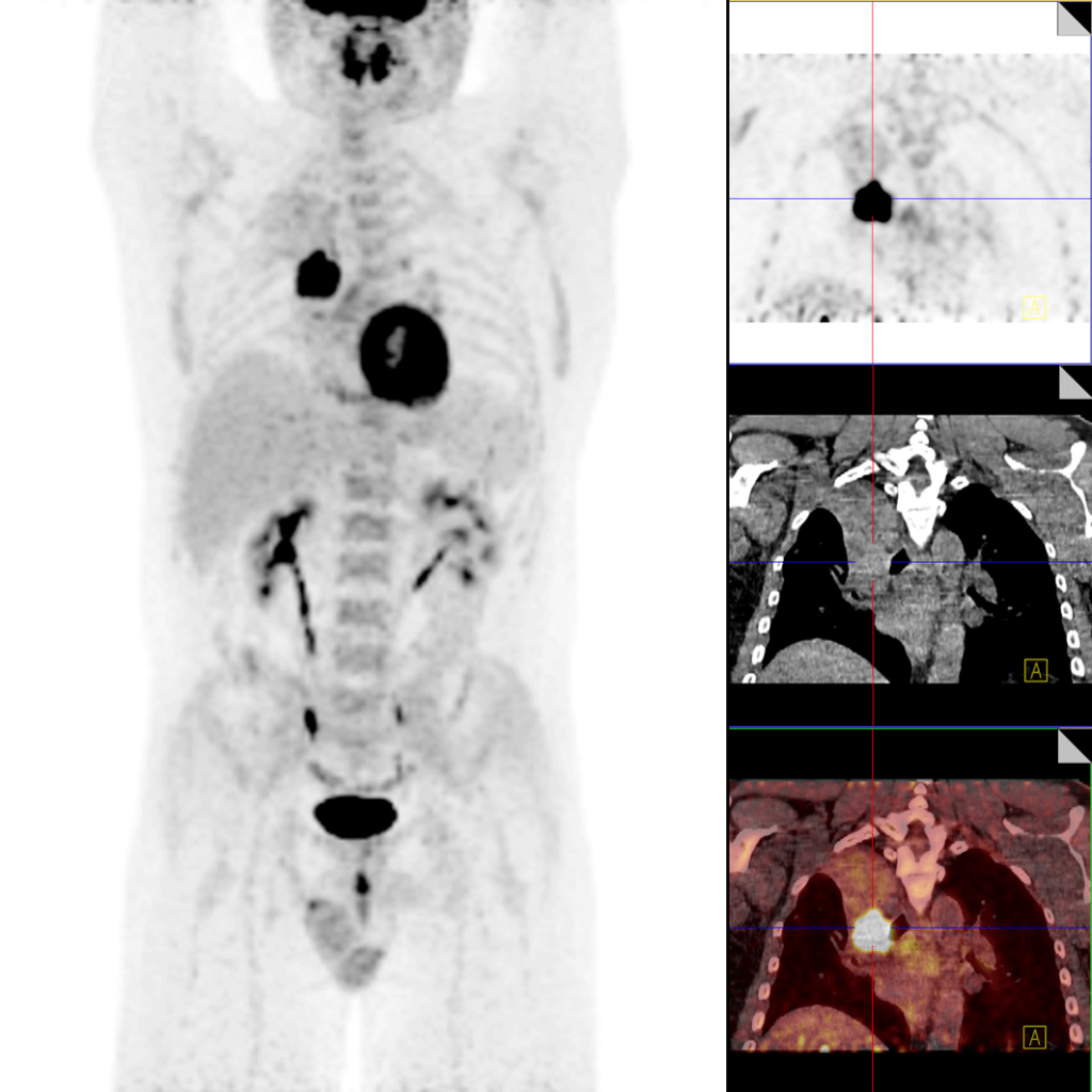 Diagnose Von Krebs - Tumorzentrum - Kantonsspital Winterthur KSW