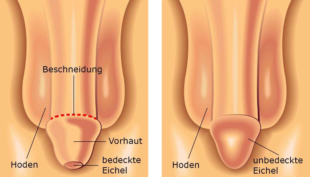 Phimose beschneidung erfahrungsbericht