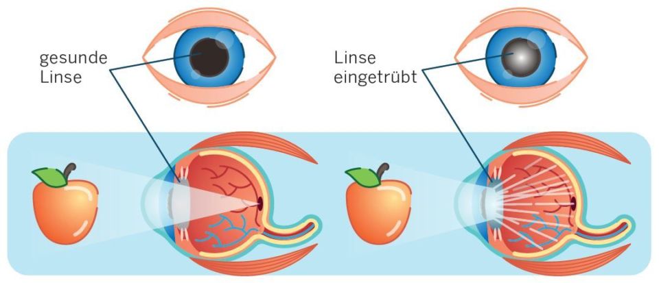 Grauer Star / Katarakt - Kantonsspital Winterthur KSW