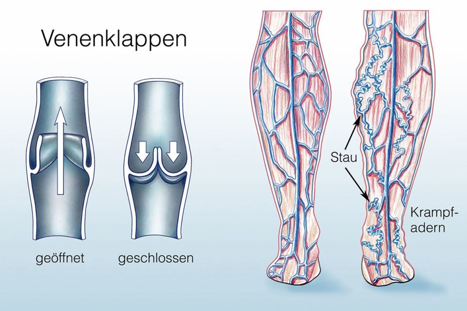 Krampfadern / Varizen Ursachen und Behandlung KSW