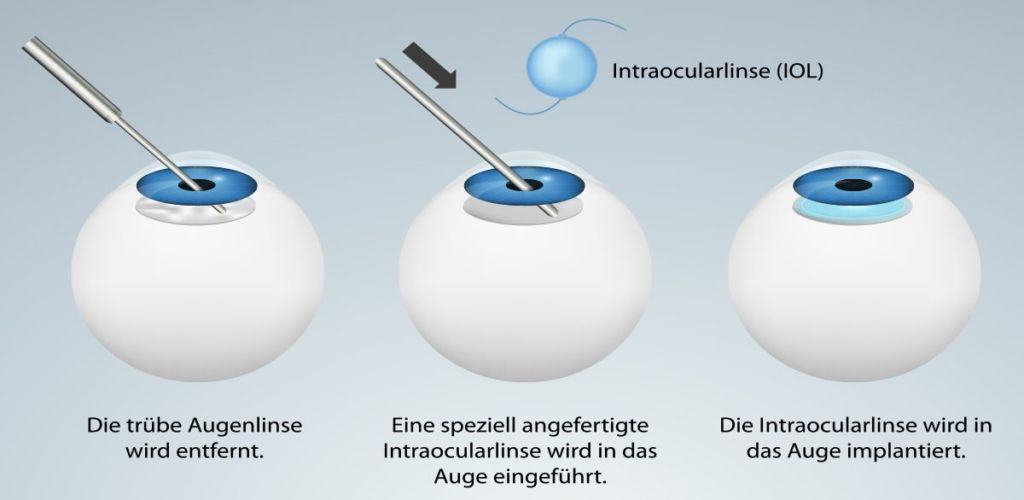 Grauer Star / Katarakt - Kantonsspital Winterthur KSW