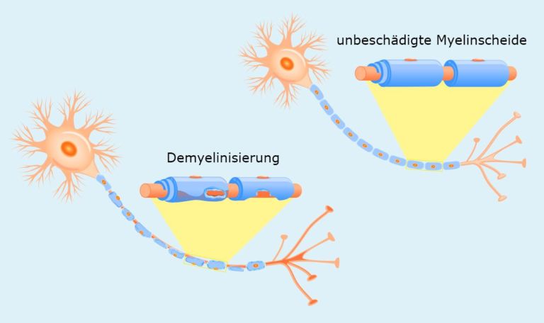 Multiple Sklerose (MS) - Symptome, Diagnose Und Behandlung - KSW