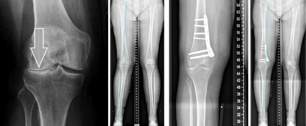 Kniearthrose bei Fehlstellungen - Krankheitsbild und ...